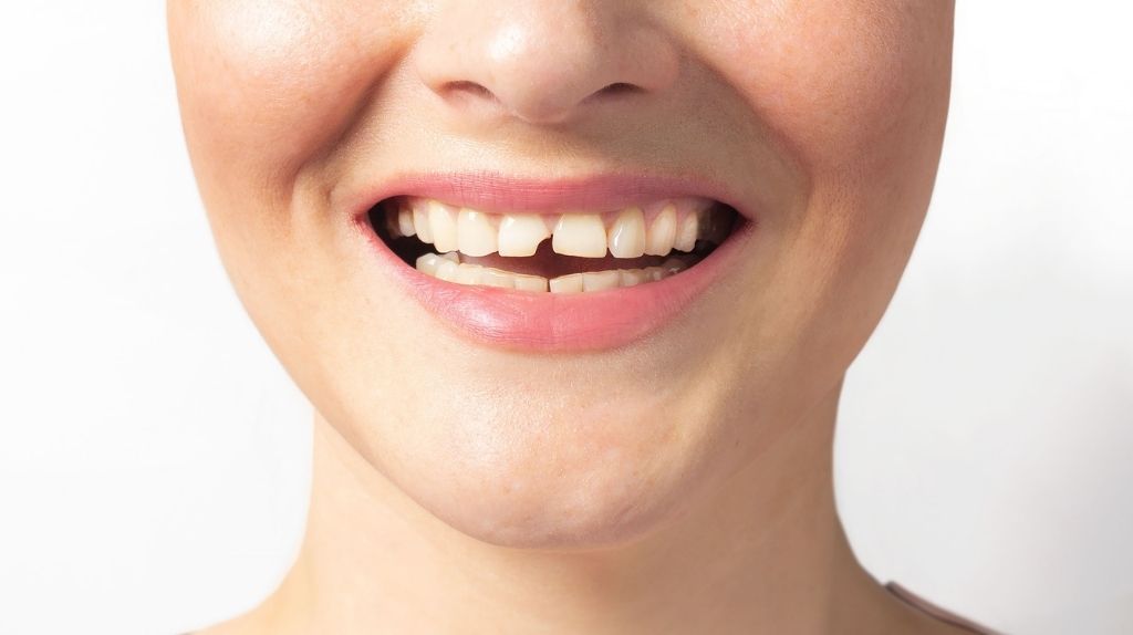 Diş Kırılması Durumunda Ne Yapılmalı?